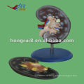 ISO 2012 Menschliche Nieren Anatomie Modell (2 Teile), Anatomie Funktion Modell HR-310-2